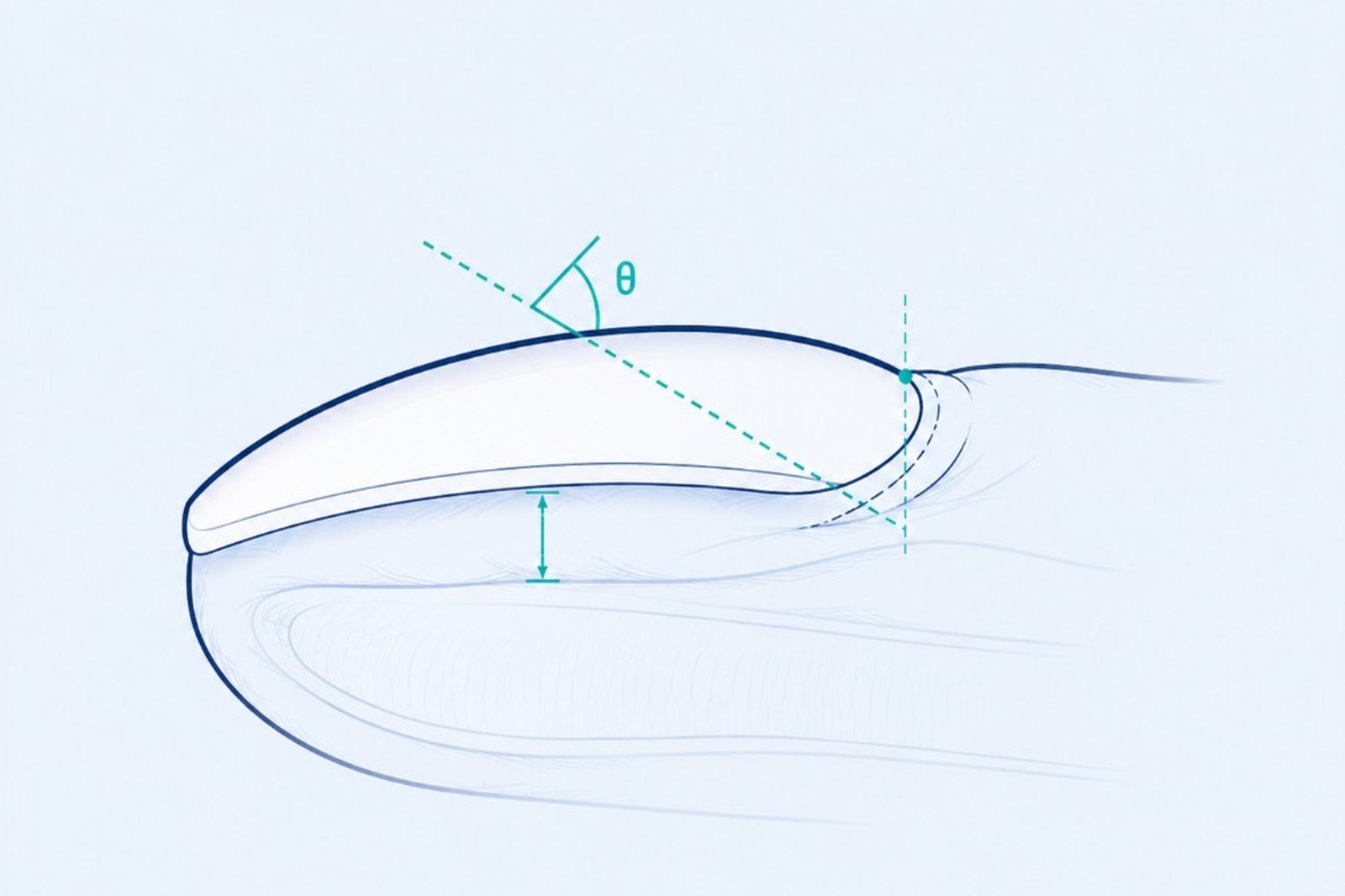 Diagram of a finger profile showing the Lovibond angle and nail-bed depth.
